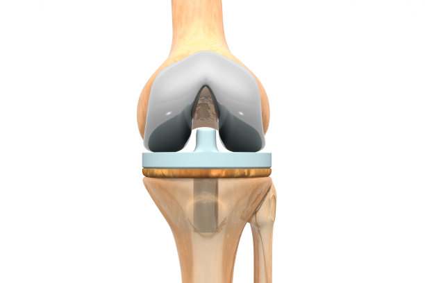 膝关节置换。三维演示图片下载