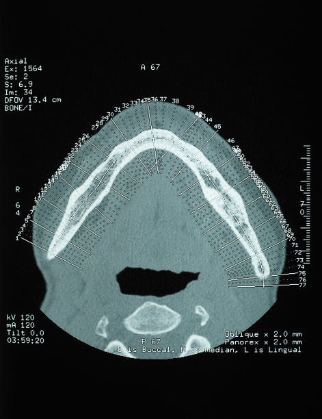 牙齿CT x光图片下载