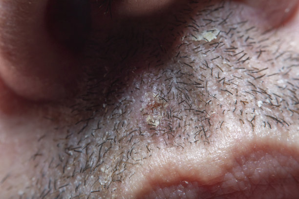 一个成年男子剃短胡须的特写。剃须时皮肤受损。短刚毛在软焦点在高倍图片下载