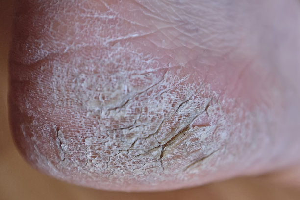 男人的腿，脚后跟有裂缝。近距离观察脚后跟开裂，需要医疗和美容治疗的足部区域。粗糙、发黄、干燥的皮肤会局部死亡。图片下载
