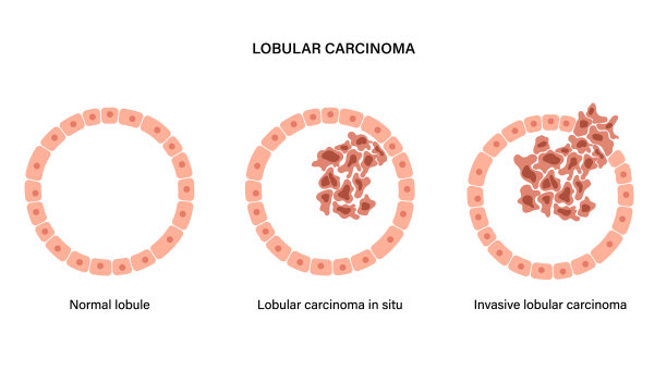 乳腺疾病的概念图片下载