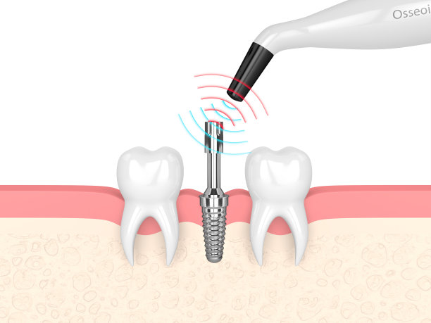 3d渲染骨结合监测装置检查种植体的稳定性图片下载