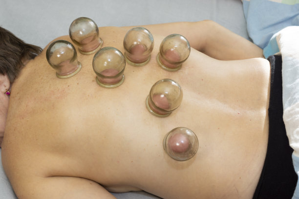 医用瓶真空治疗背部病人妇女图片下载