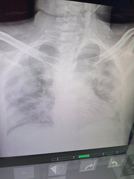 我的第一个covid-19患者图片下载