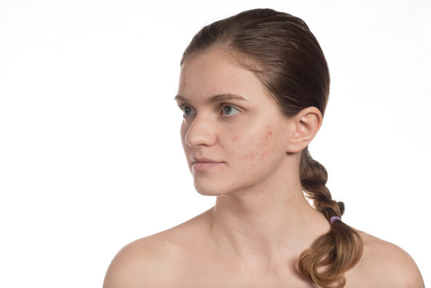 一个脸上长着红白痘痘的漂亮女孩。前后用海绵涂抹。在白色背景上停止痤疮。图片下载