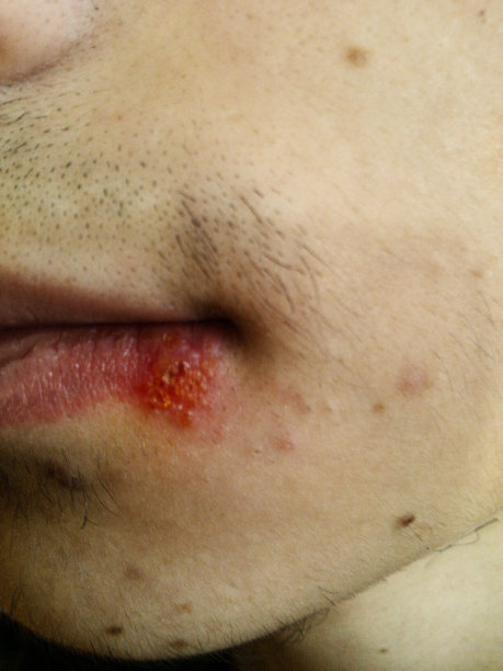 一个少年的嘴与单纯疱疹的特写图片下载