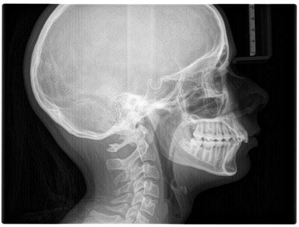 侧位颅骨x光片图片下载