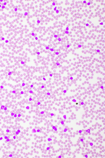 急性淋巴细胞白血病或血液涂片中的ALL细胞图片下载