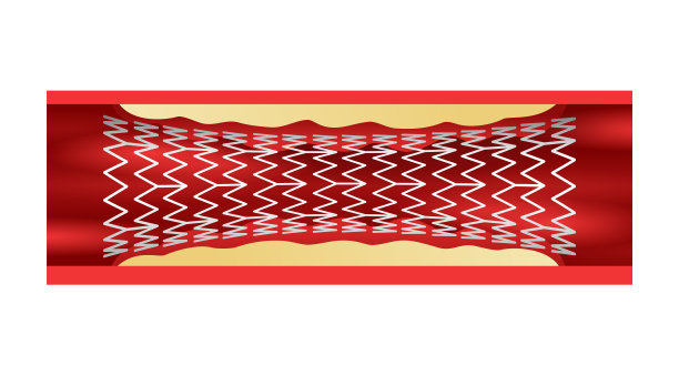 冠状动脉支架在血管中保持通道图片下载