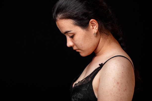 一个年轻女孩脸上和身体上的痤疮和丘疹。在一个孤立的背景下医学和美容的概念图片下载