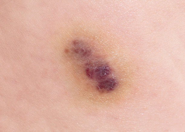 二度烧伤的愈合过程:在以前的烧伤伤口的皮肤下有血泡和瘀伤。图片下载