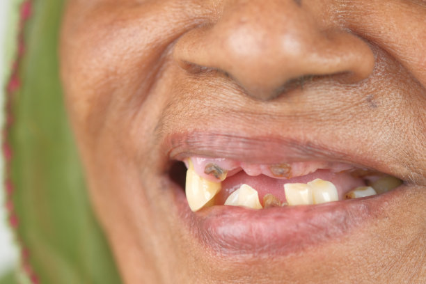 近距离观察老年妇女的龋齿和一些破碎的牙齿图片下载