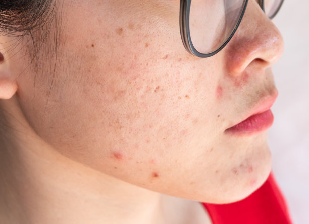 裁剪镜头的女人有问题的痤疮在她的脸上发炎。图片下载