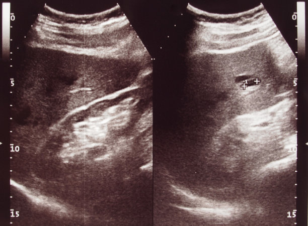 腹部超声诊断图片下载