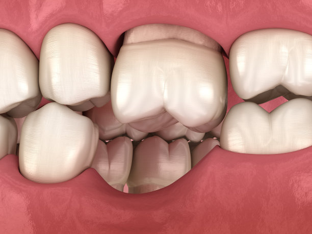 失臼齿后牙齿移位变形。Popov Godon现象的3D插图图片下载