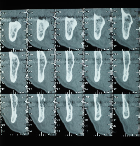 牙齿CT x光图片下载