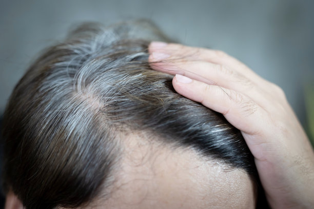 一个男人有头发生长，他有脱发的问题。干性头皮,头皮屑图片下载