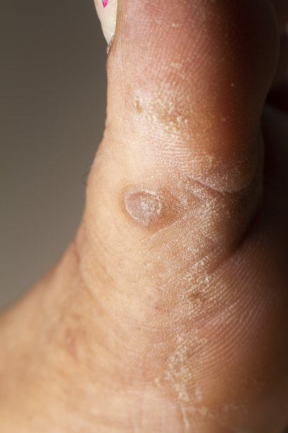 一个女人的腿的特写患有慢性牛皮癣在一个白色的背景。病人皮肤上的皮疹和鳞屑的特写。皮肤问题。干燥的皮肤。图片下载