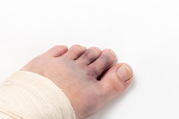 一名男子的腿上缠着弹性绷带，有淤青图片下载