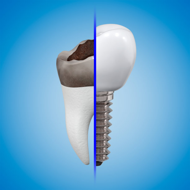 用植入物替换受损牙齿的概念。龋齿和植牙冠。3 d渲染。图片下载