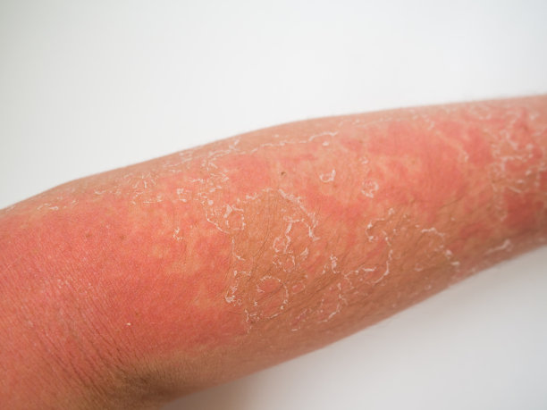 皮肤被晒伤，手臂被晒黑图片下载