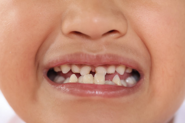 亚洲小男孩笑着，第一颗恒牙和第一颗乳牙被打破。图片下载