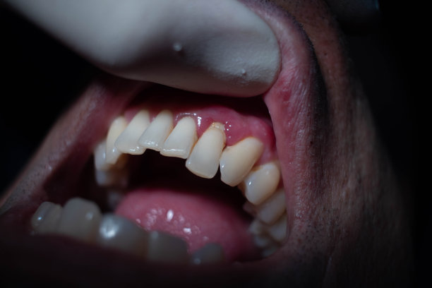 牙医戴着白手套为病人开口治疗图片下载