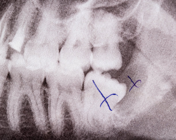 牙齿x线照片，移除智齿和牙齿发炎囊肿，宏观。牙科外科概念，臼齿图片下载