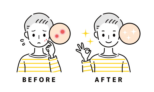 一个患有痤疮的男人。图片下载