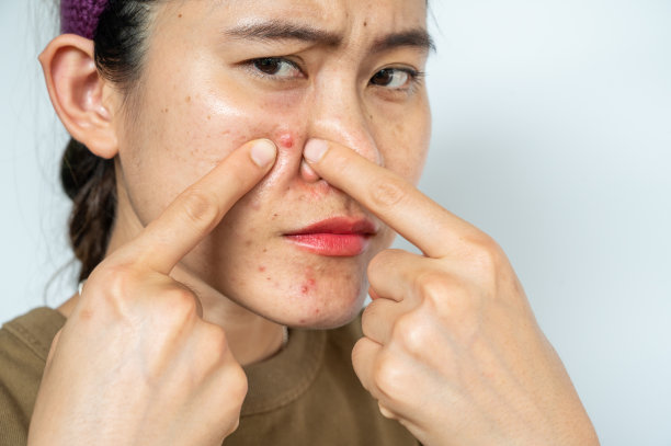 一个亚洲女人指着她脸上的粉刺。图片下载