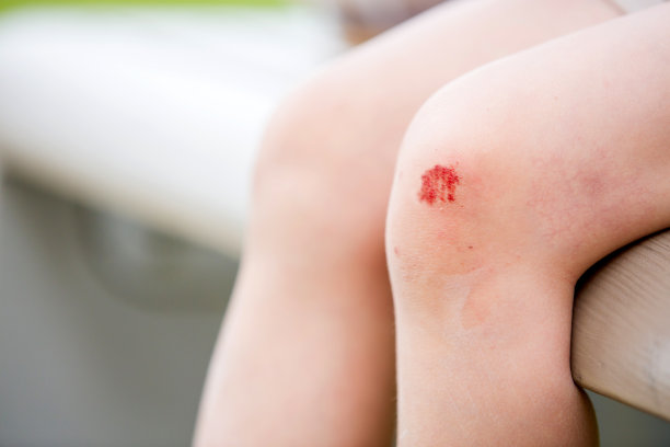 金发小孩，可爱的小男孩摔伤了膝盖图片下载