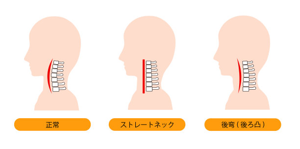 这是一个直颈(文字颈)，颈椎后凸和正常颈骨的插图。图片下载