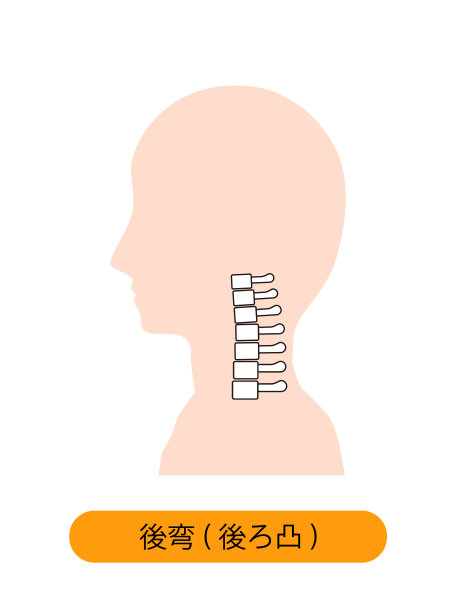 这是伴有颈椎后凸的颈骨的图示。图片下载