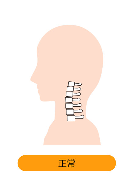 这是一个正常颈骨的图解。图片下载