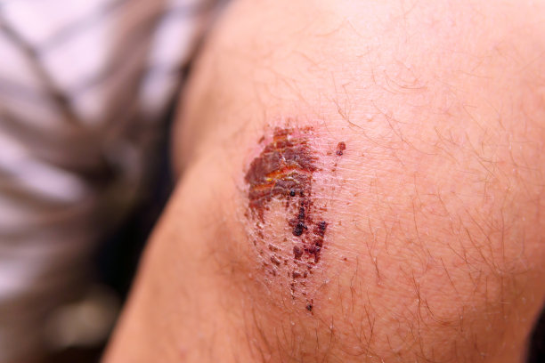 皮肤上有很深的抓痕，膝盖上有瘀伤。特写镜头选择聚焦图片下载