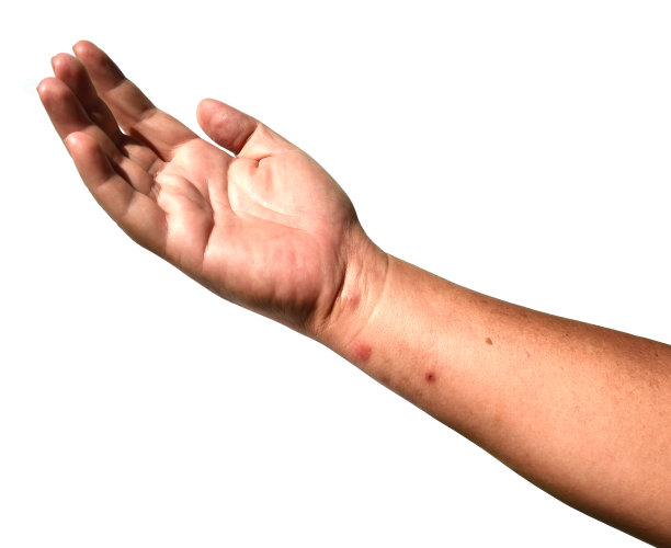 人类手臂和手部皮肤上的皮疹和红水泡呈锯齿状分布在白色的背景上图片下载