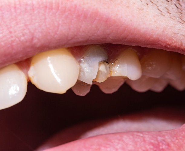 一颗黑色的死牙，其中有一块牙釉质脱落，牙齿碎片。现代牙科修复的概念，宏观图片下载