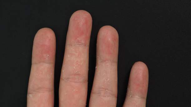 手部和手指皮肤脱皮，在黑色背景上隔离。孤立的图片下载