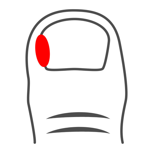 甲真菌病指甲细线象人图片下载