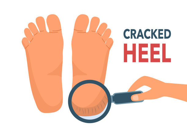 手持放大镜与裂纹后跟在平面设计上的白色背景。近距离观察干燥黑裂的脚后跟皮肤。图片下载
