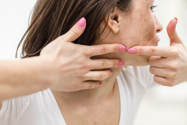 照片上的女人与痤疮问题挤痘痘室内。图片下载