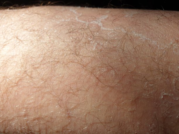 皮肤病。皮肤疾病的特写。图片下载