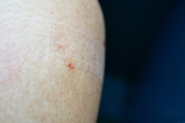 服用后手臂上的血与冠状病毒疫苗有关。图片下载