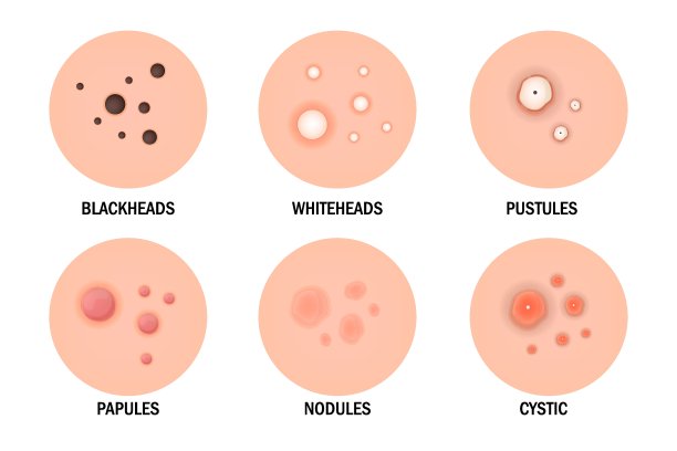 痤疮类型集。皮肤病、皮肤病、美容概念。图片下载