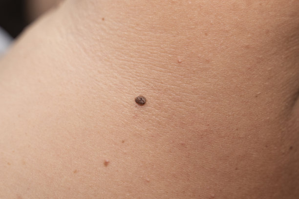 人类皮肤上一颗痣的微距照片，危险的皮肤痣-黑素瘤图片下载