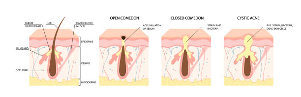 类型的痤疮。开粉刺，闭粉刺，炎症性痤疮，囊性痤疮。健康护肤理念图片下载