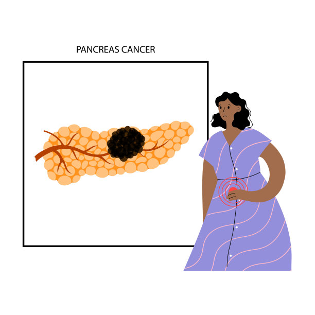 胰腺疾病和癌症图片下载