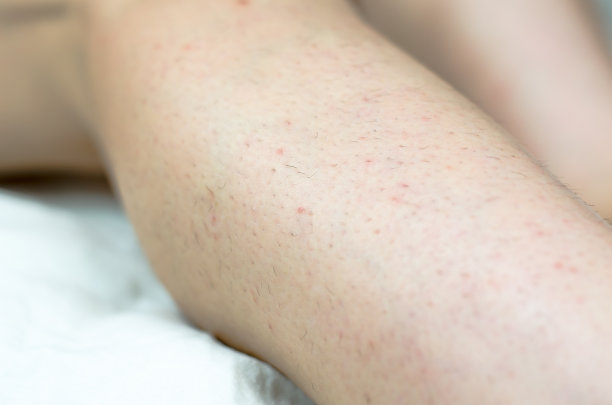 女性腿上的毛发。向内生长的头发问题。多毛的女性腿接近。图片下载