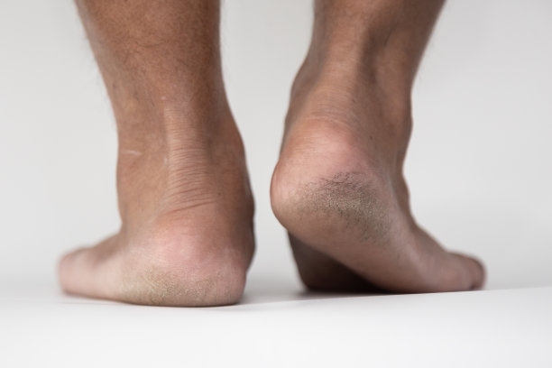 脚部皮肤的脏茧，坚硬的脚部皮肤。图片下载