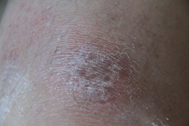 受损皮肤图片下载